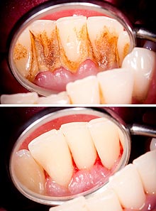 Zähne mit und ohne Zahnstein